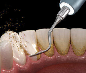 Deep Teeth Cleaning