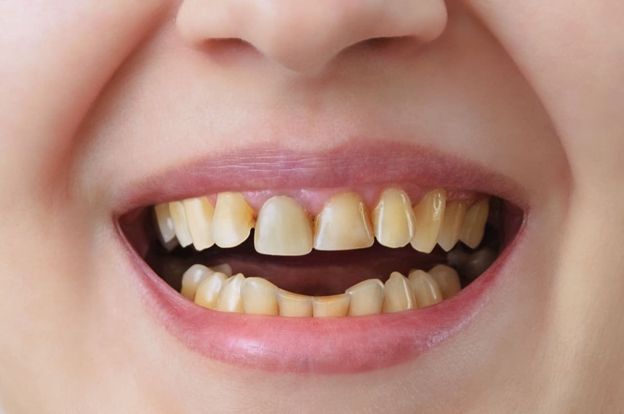 Does Tea Stain Your Teeth More Than Coffee? Mouth and Smiles